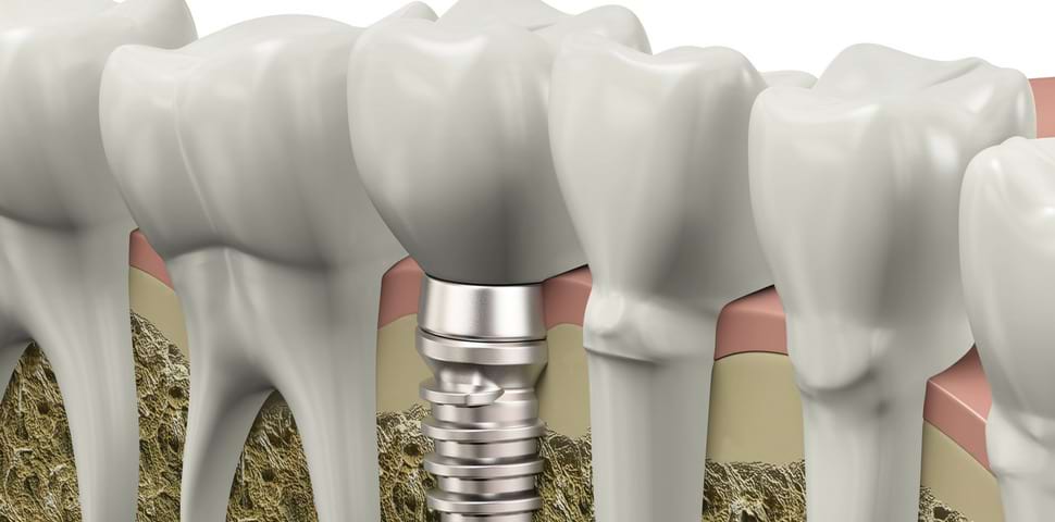 If you have lost a tooth, dental implants are the best solution