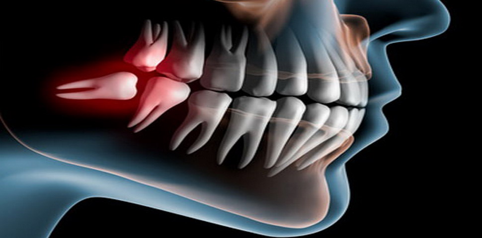 Problems with wisdom teeth