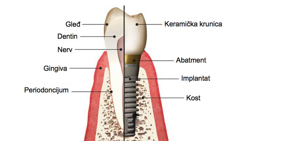 Procedure of implant placement 