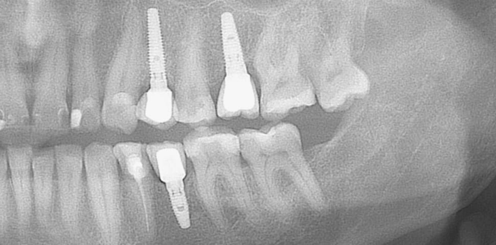 Spiral titanic implants are the best replacement for a missing tooth