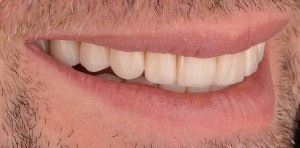 Non-metal crowns