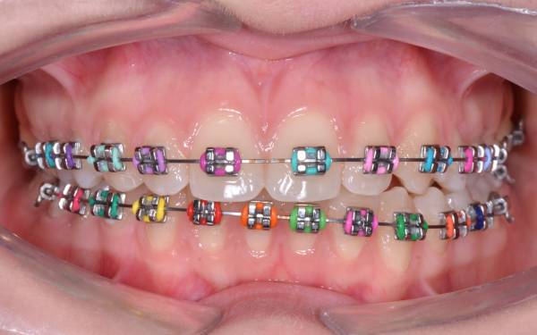 Orthodontic treatment